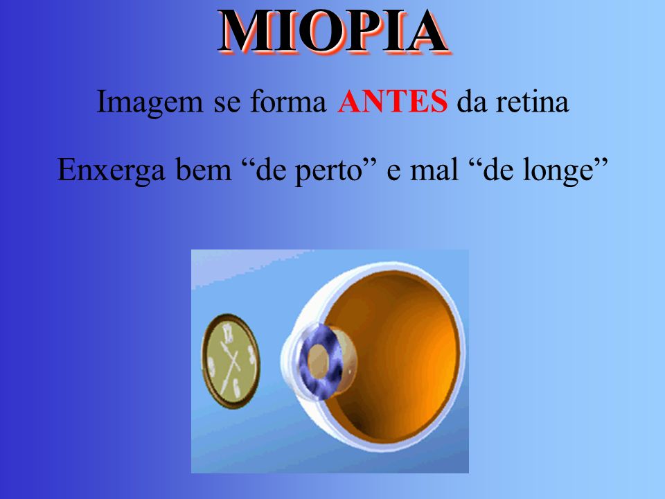MIOPIA Imagem se forma ANTES da retina