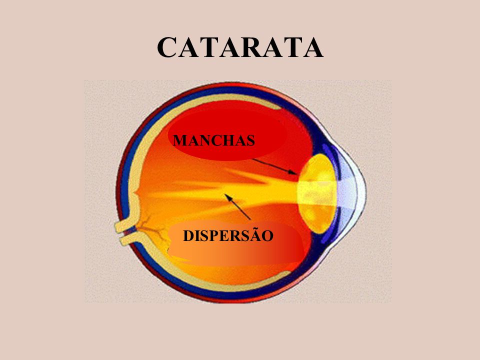 CATARATA MANCHAS DISPERSÃO
