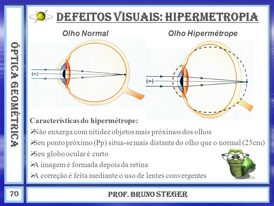 DEFEITOS VISUAIS: Hipermetropia