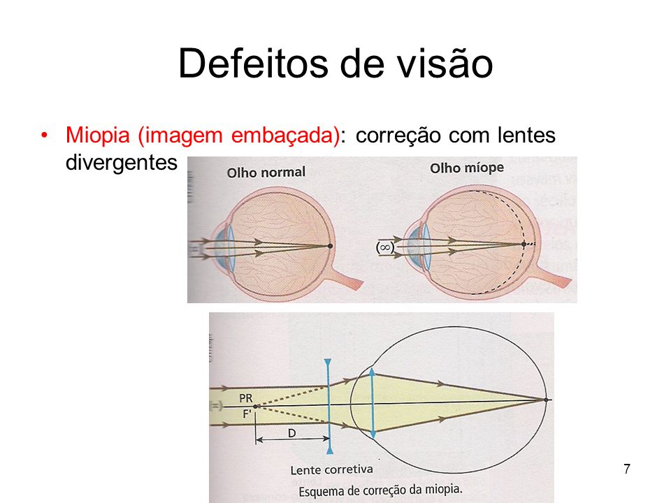 Defeitos de visão Miopia (imagem embaçada): correção com lentes divergentes