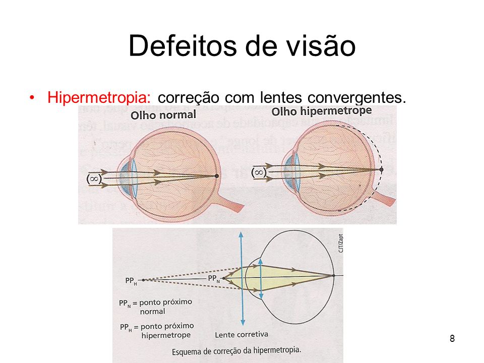 Defeitos de visão Hipermetropia: correção com lentes convergentes.