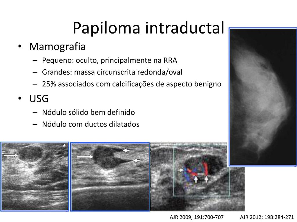 papiloma intraductal focal)