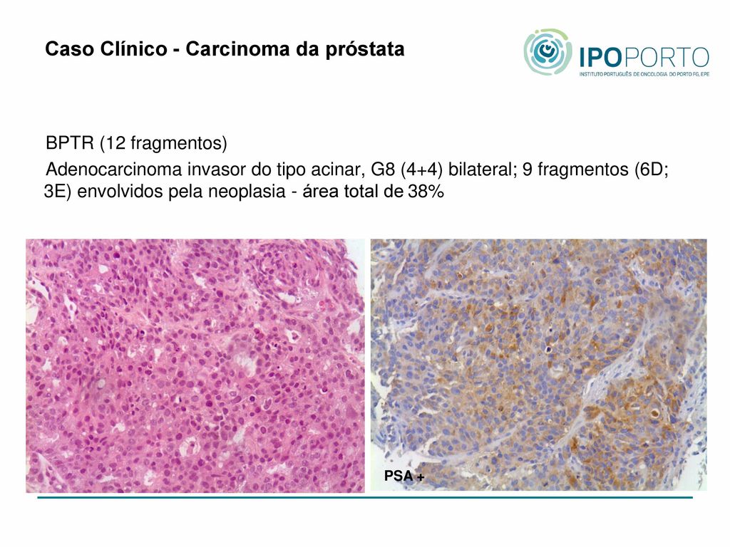 adenocarcinoma acinar da próstata gleason 7