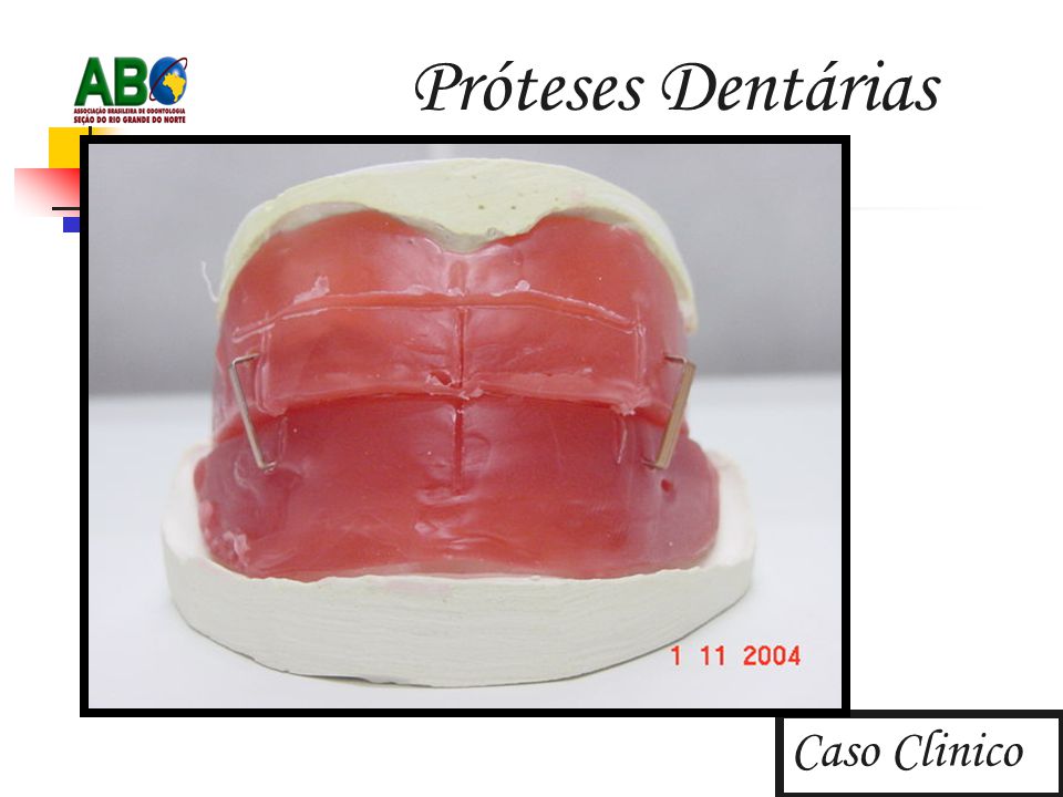 Próteses Dentárias Caso Clinico
