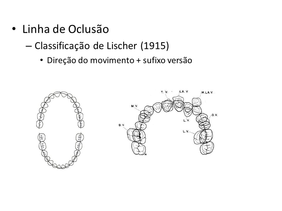 Linha de Oclusão Classificação de Lischer (1915)
