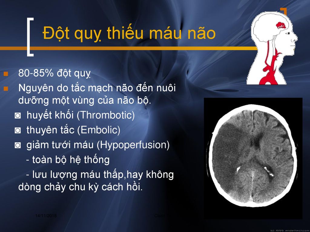 Đột quỵ thiếu máu não 80-85% đột quỵ