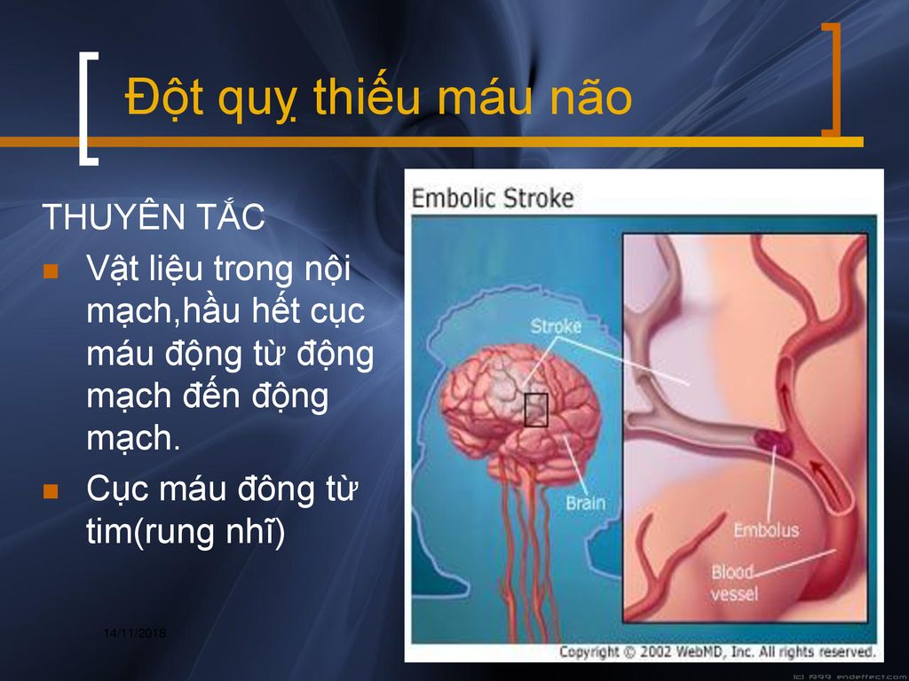 Đột quỵ thiếu máu não THUYÊN TẮC