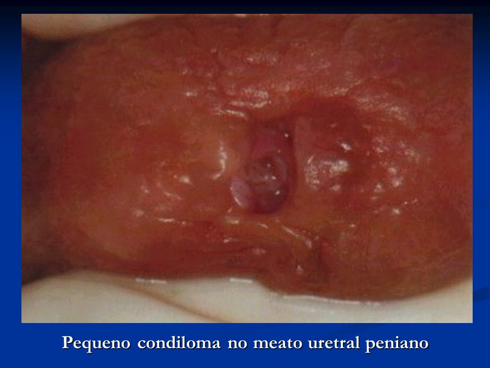 condiloame în uretra la bărbați tratament cel mai bun tratament pentru paraziti