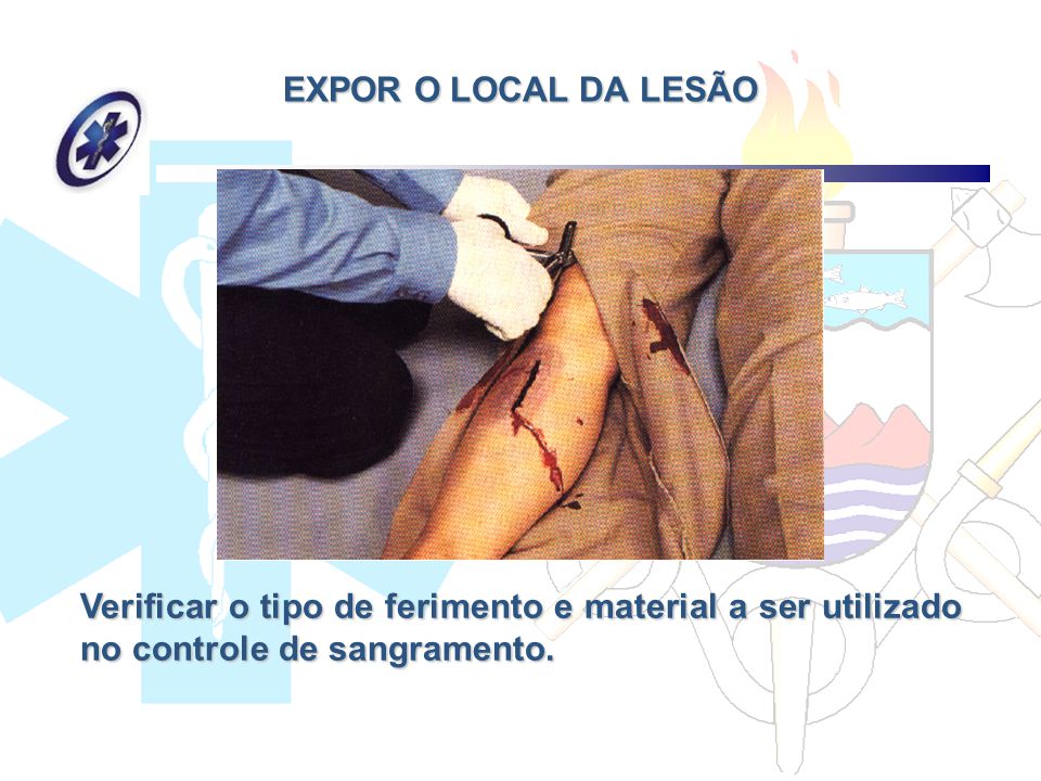 EXPOR O LOCAL DA LESÃO Verificar o tipo de ferimento e material a ser utilizado no controle de sangramento.