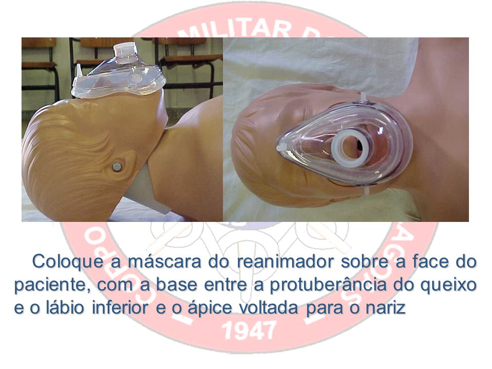 Coloque a máscara do reanimador sobre a face do paciente, com a base entre a protuberância do queixo e o lábio inferior e o ápice voltada para o nariz