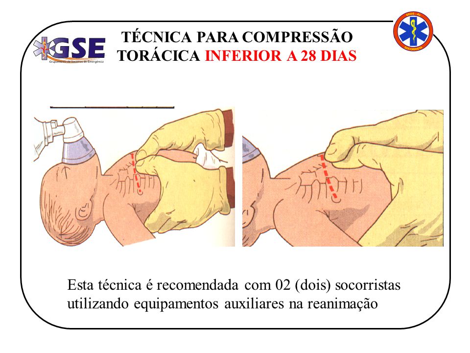 TÉCNICA PARA COMPRESSÃO TORÁCICA INFERIOR A 28 DIAS