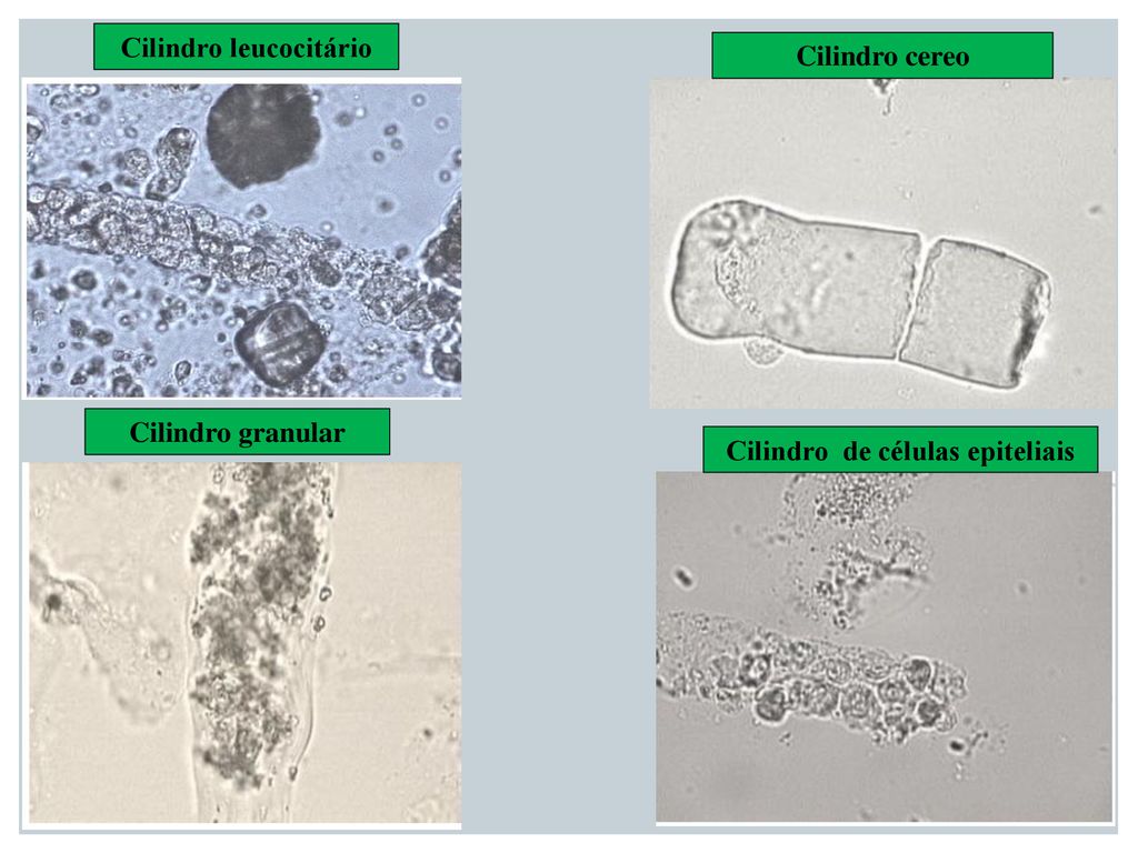 Cilindro leucocitário Cilindro de células epiteliais