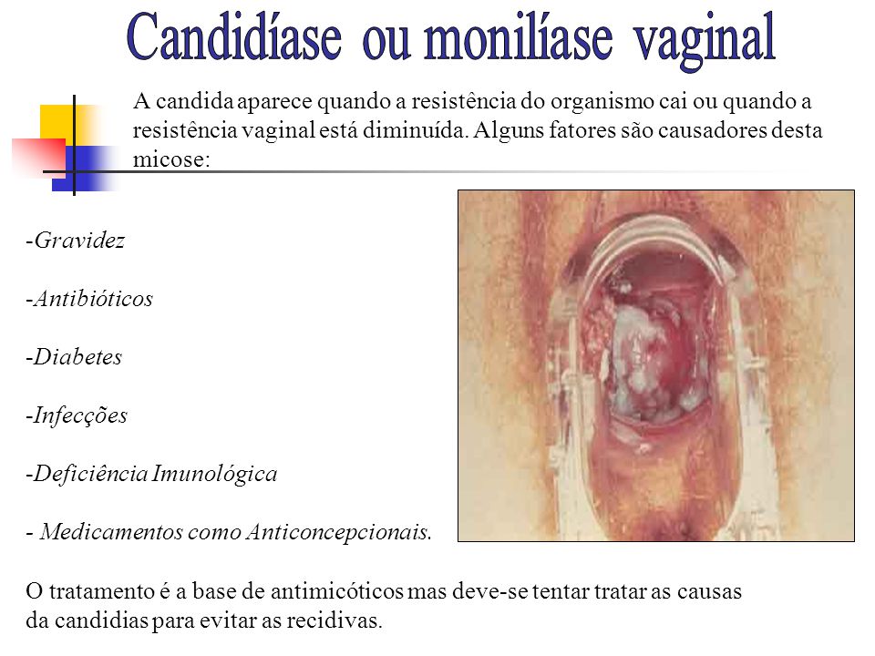 Candidíase ou monilíase vaginal