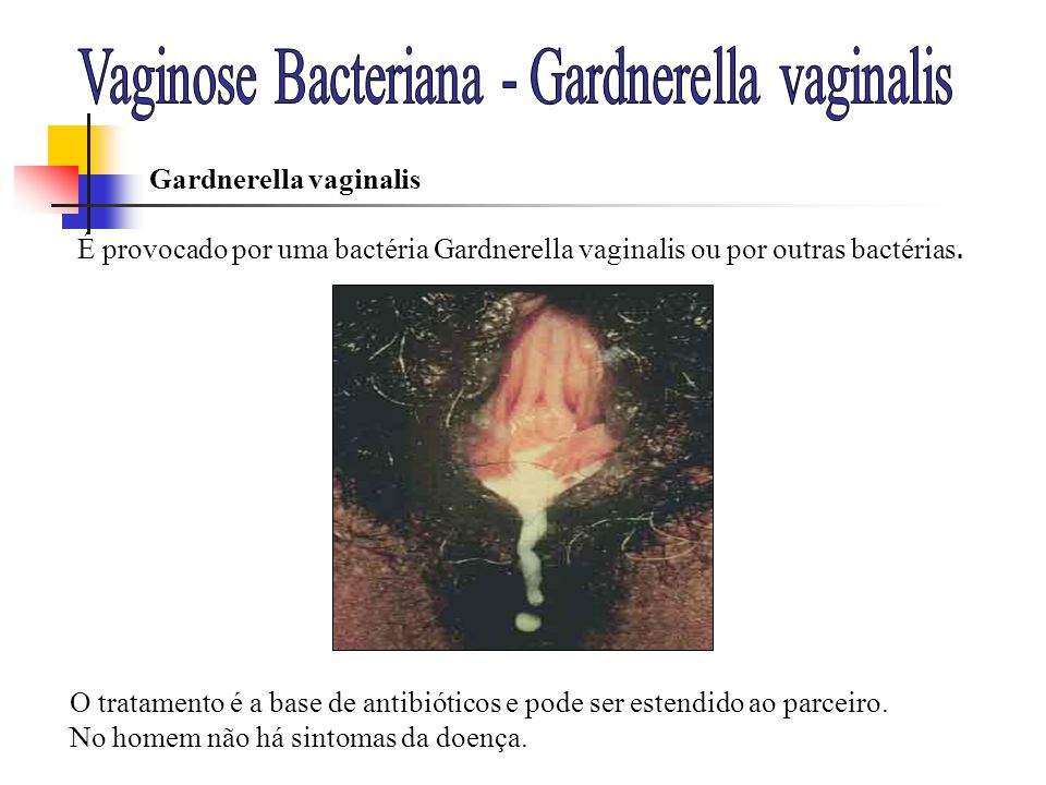 Vaginose Bacteriana - Gardnerella vaginalis
