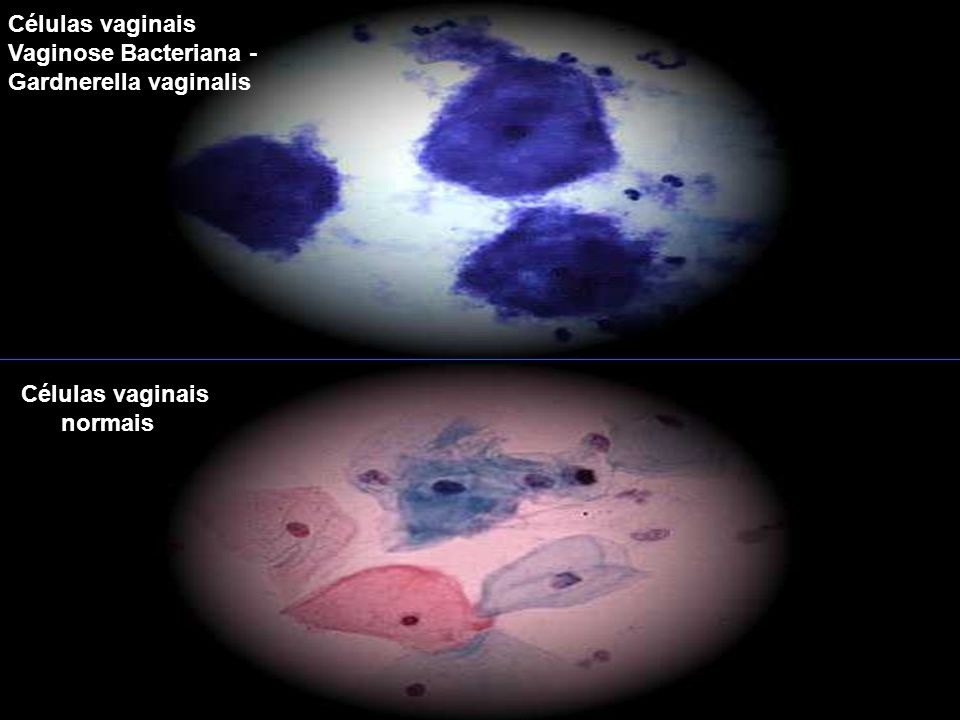 Células vaginais Vaginose Bacteriana - Gardnerella vaginalis Células vaginais normais