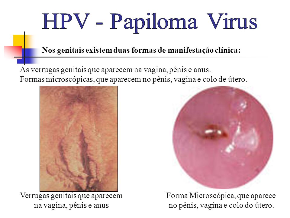 HPV - Papiloma Virus Nos genitais existem duas formas de manifestação clínica: As verrugas genitais que aparecem na vagina, pênis e anus.