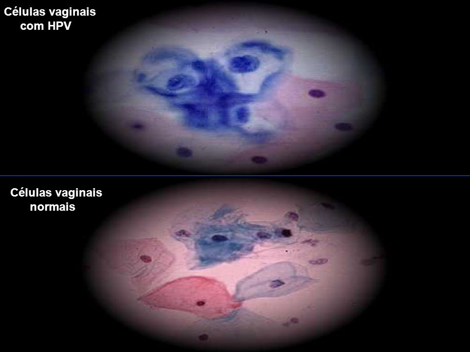 Células vaginais com HPV Células vaginais normais