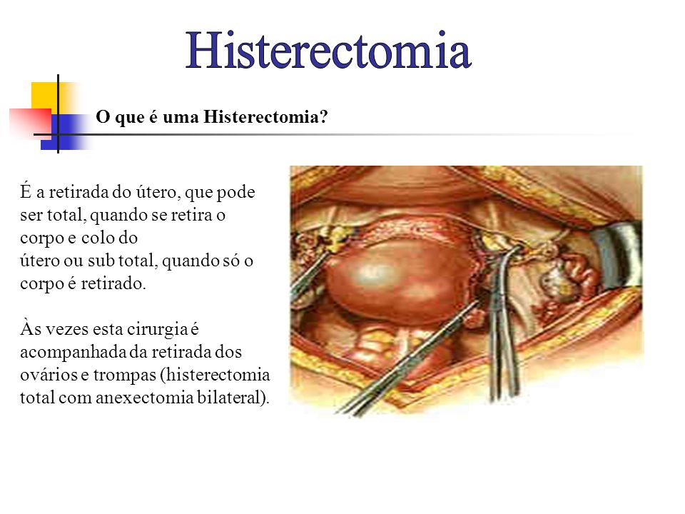 Histerectomia O que é uma Histerectomia