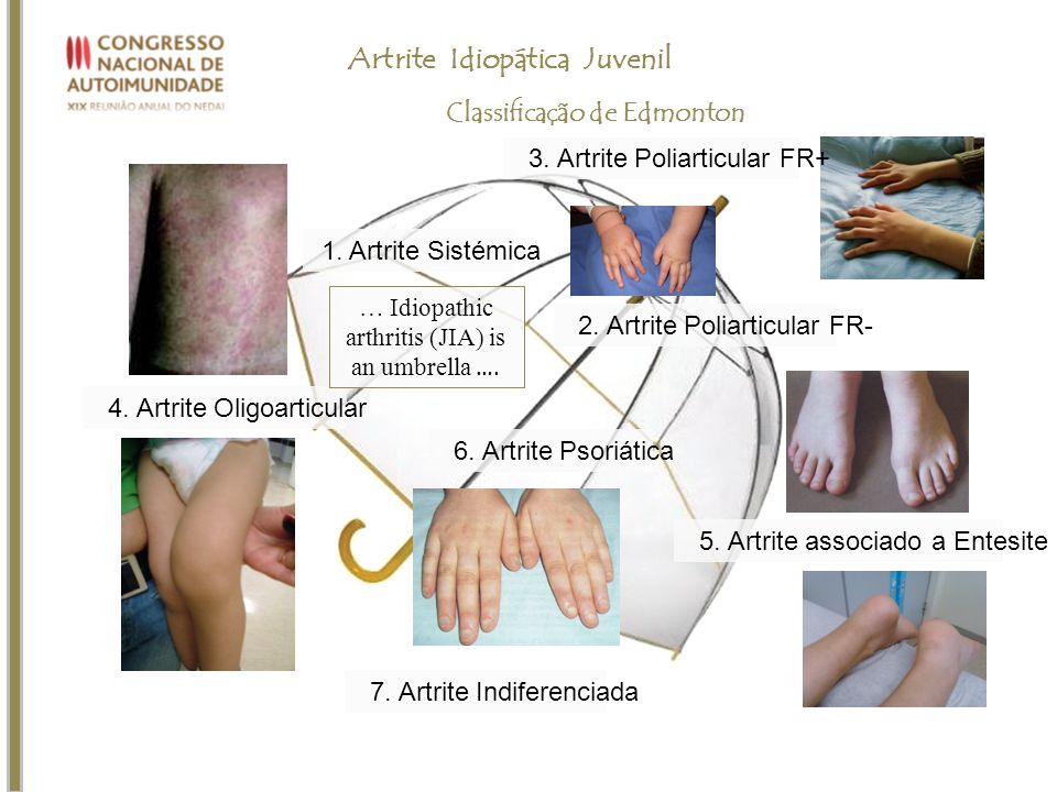 Artrita idiopatica juvenila – ce trebuie sa cunoasca parintii | detectivcluj.ro