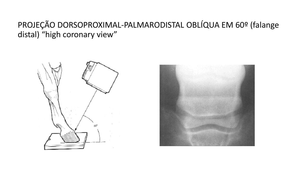 PROJEÇÃO DORSOPROXIMAL-PALMARODISTAL OBLÍQUA EM 60º (falange distal) high coronary view