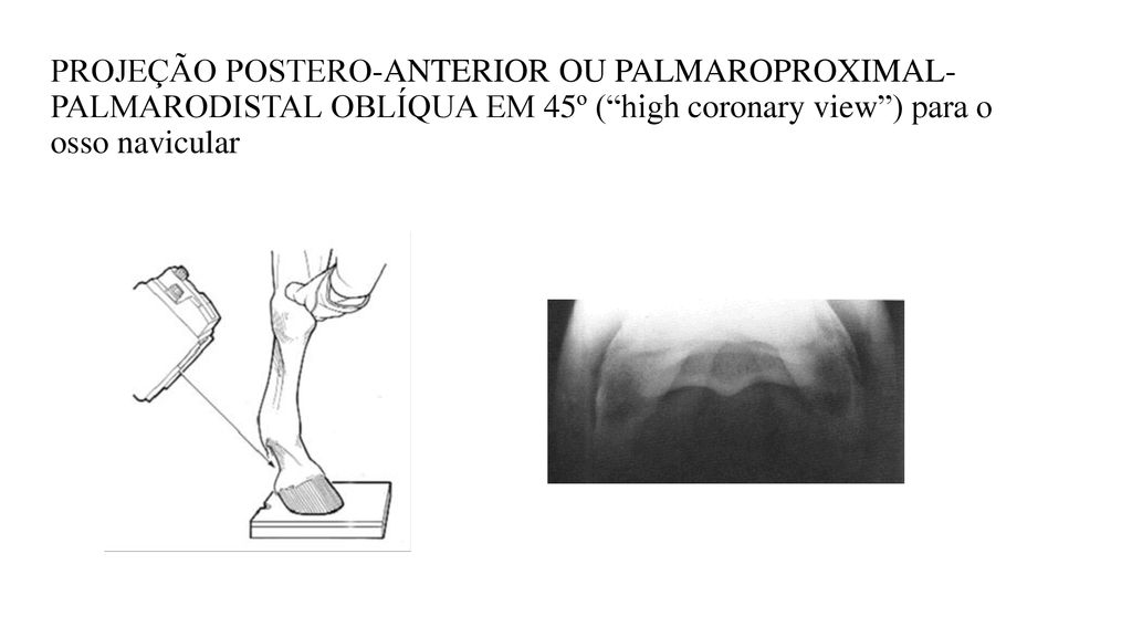 PROJEÇÃO POSTERO-ANTERIOR OU PALMAROPROXIMAL- PALMARODISTAL OBLÍQUA EM 45º ( high coronary view ) para o osso navicular