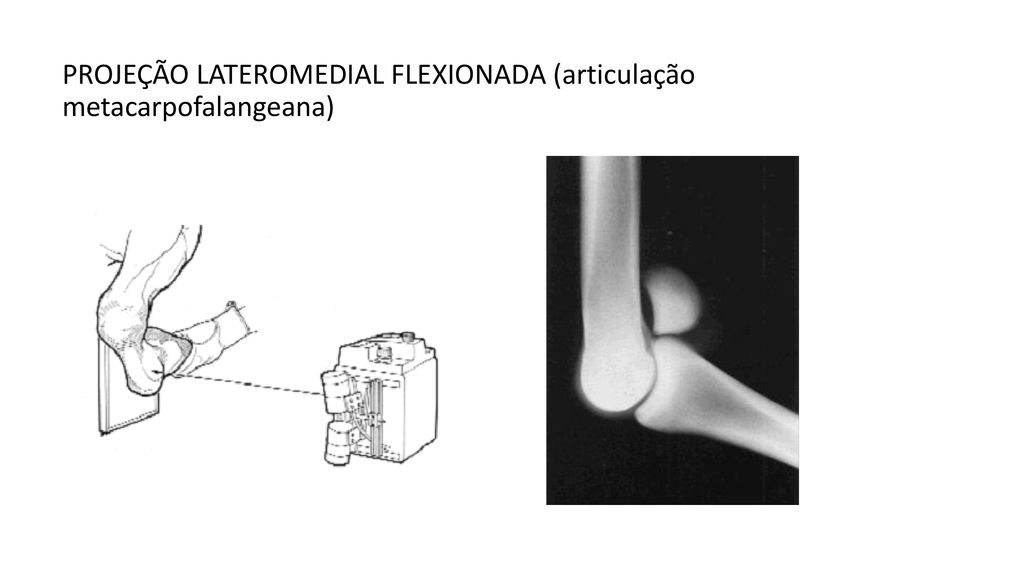 PROJEÇÃO LATEROMEDIAL FLEXIONADA (articulação metacarpofalangeana)