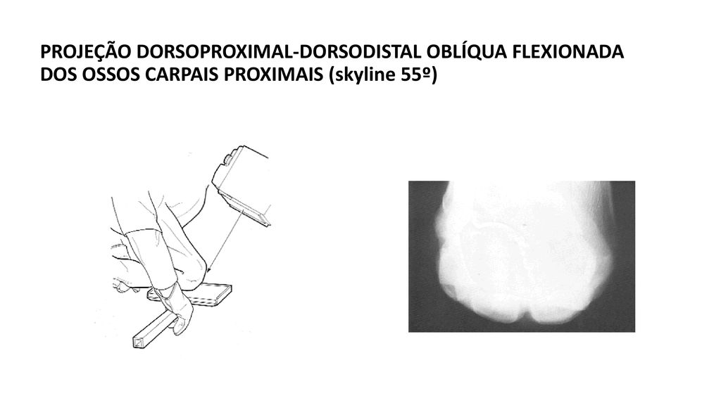 PROJEÇÃO DORSOPROXIMAL-DORSODISTAL OBLÍQUA FLEXIONADA DOS OSSOS CARPAIS PROXIMAIS (skyline 55º)