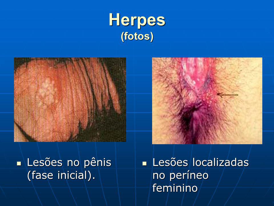 Herpes (fotos) Lesões no pênis (fase inicial).