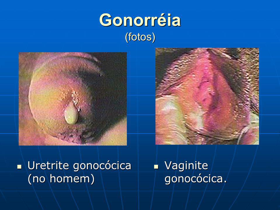 Gonorréia (fotos) Uretrite gonocócica (no homem) Vaginite gonocócica.