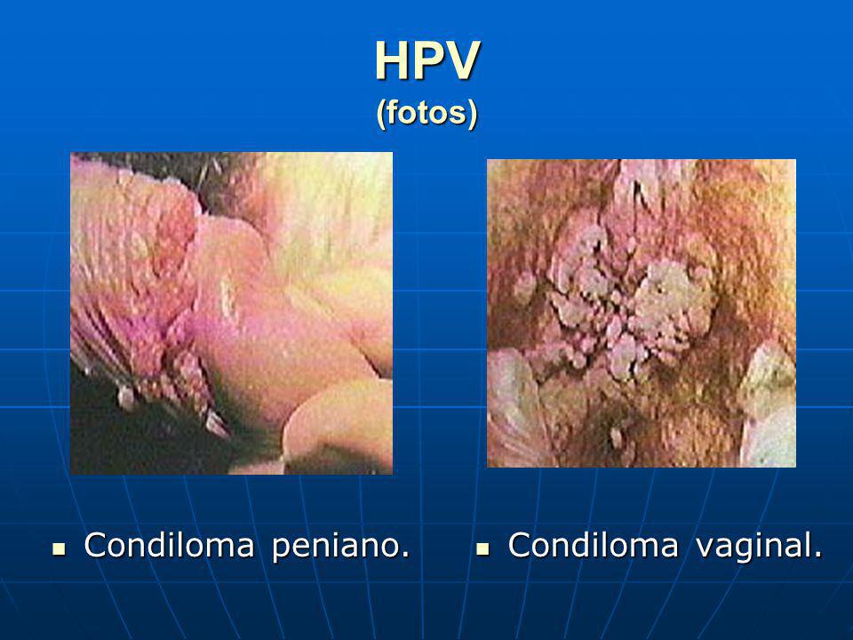 HPV (fotos) Condiloma peniano. Condiloma vaginal.