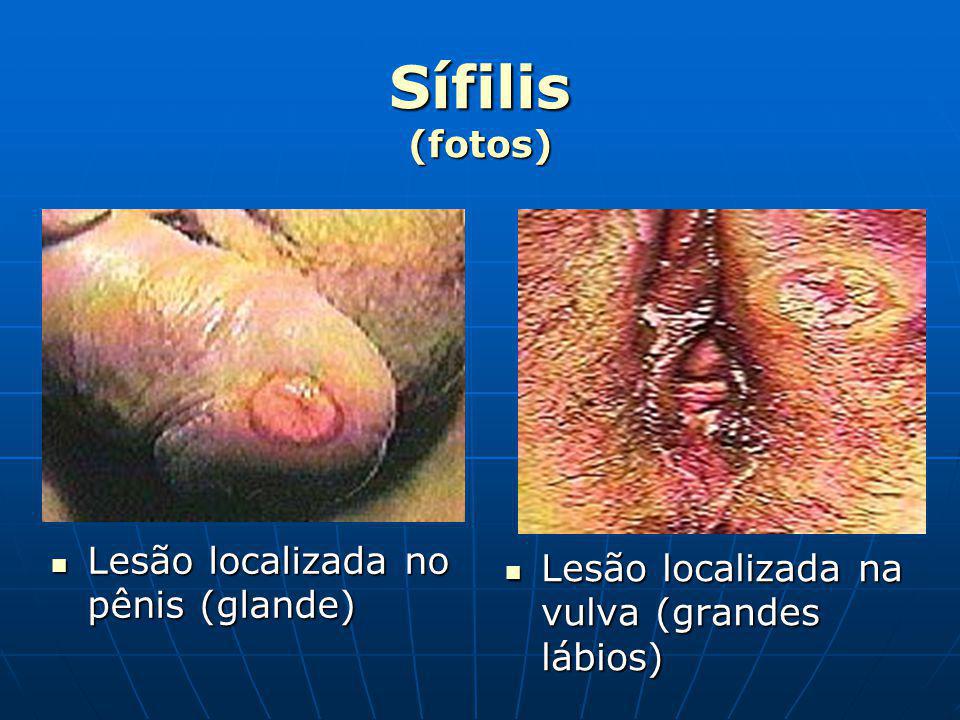 Sífilis (fotos) Lesão localizada no pênis (glande)