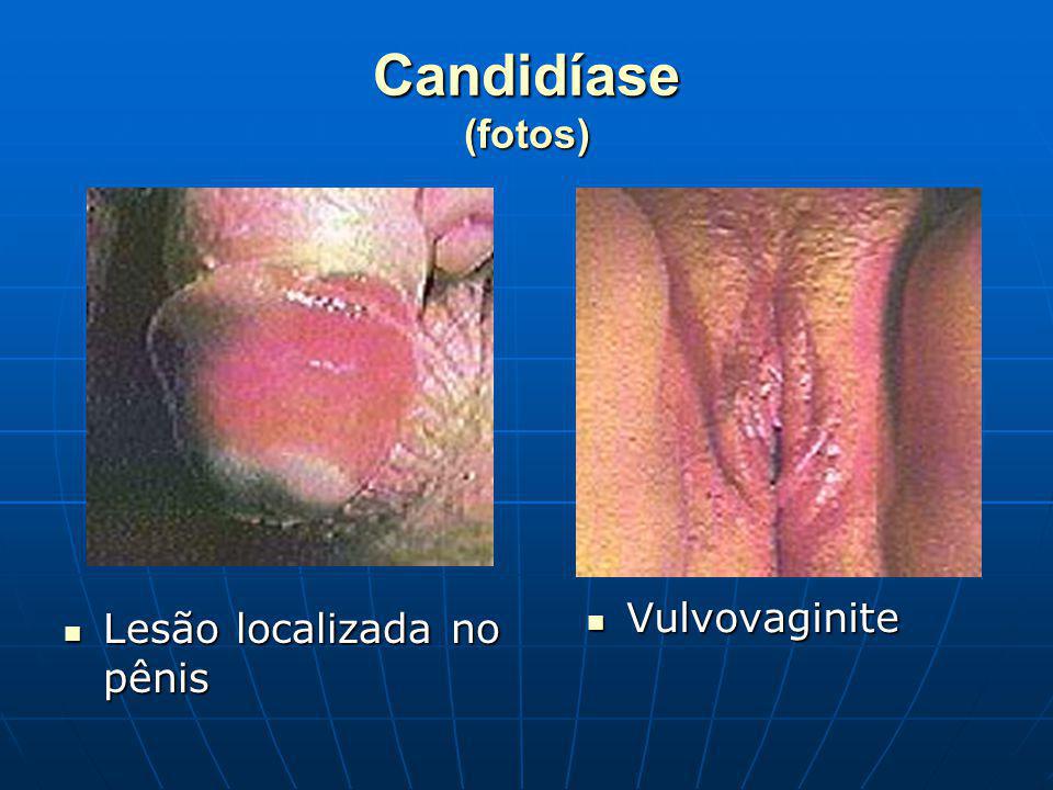 Candidíase (fotos) Vulvovaginite Lesão localizada no pênis