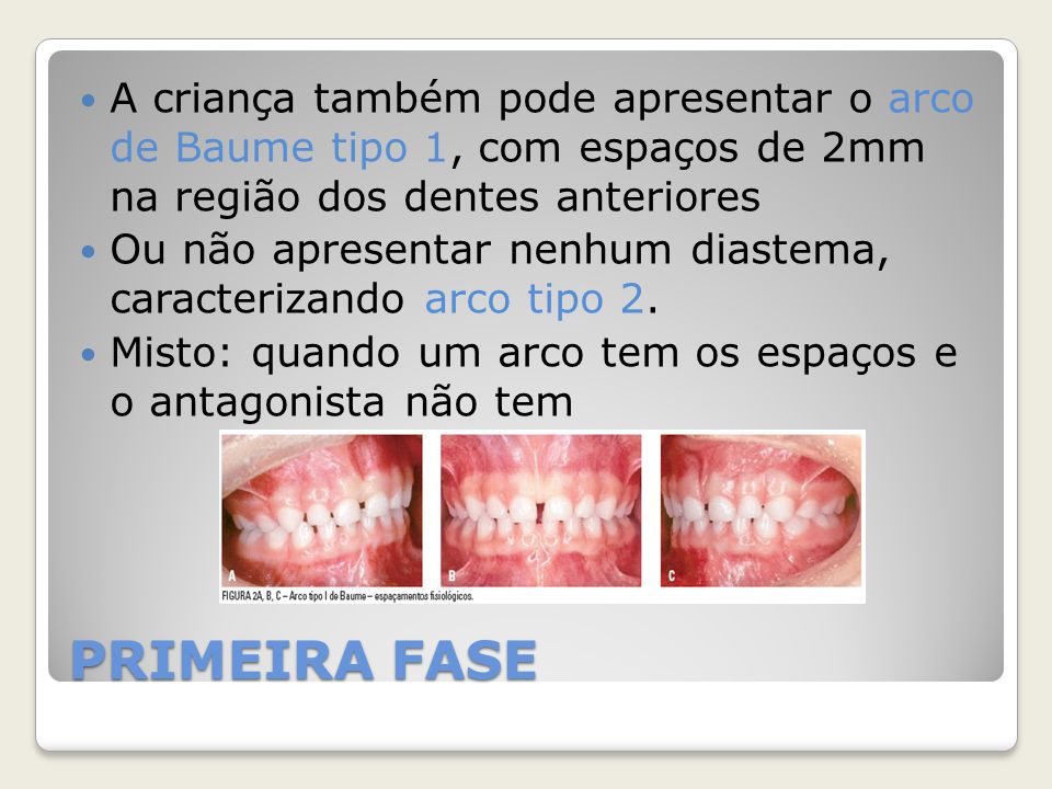 A criança também pode apresentar o arco de Baume tipo 1, com espaços de 2mm na região dos dentes anteriores