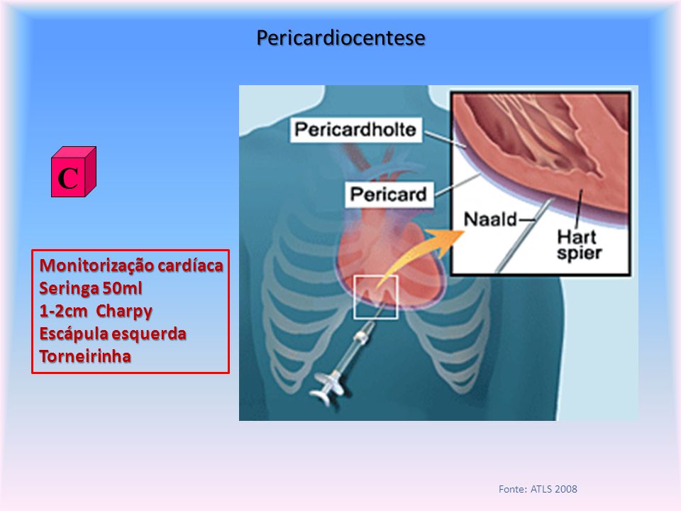 C Pericardiocentese Monitorização cardíaca Seringa 50ml 1-2cm Charpy