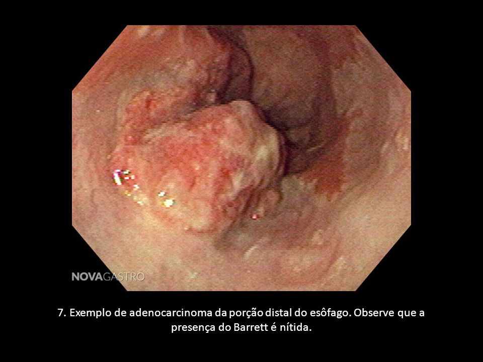 7. Exemplo de adenocarcinoma da porção distal do esôfago