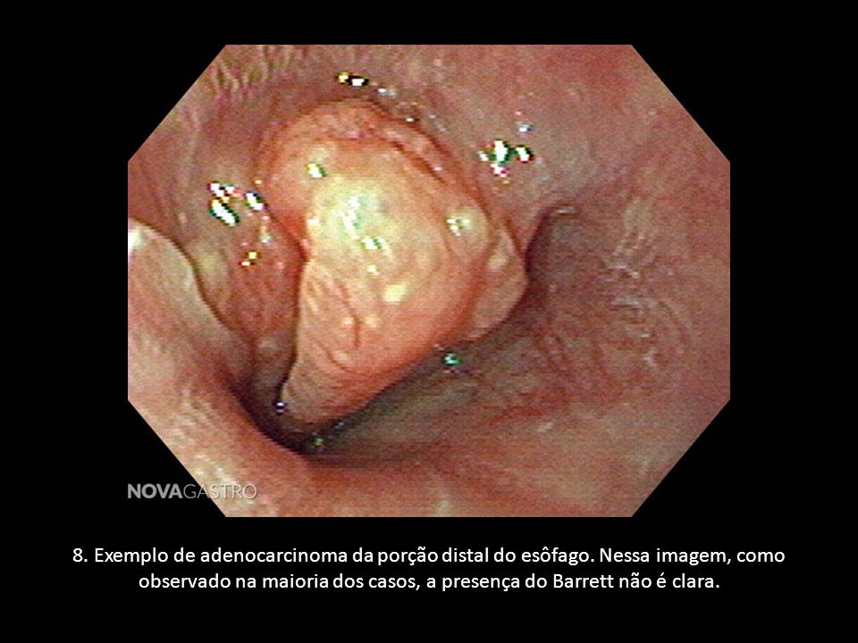 8. Exemplo de adenocarcinoma da porção distal do esôfago