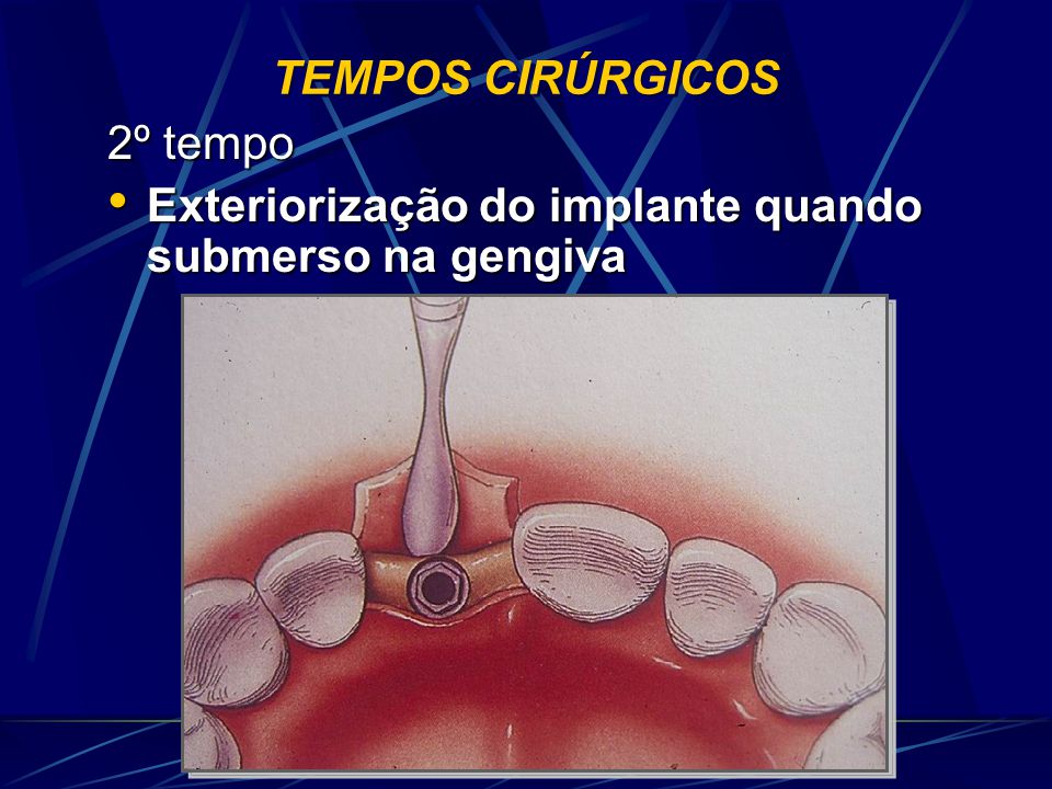 TEMPOS CIRÚRGICOS 2º tempo Exteriorização do implante quando submerso na gengiva