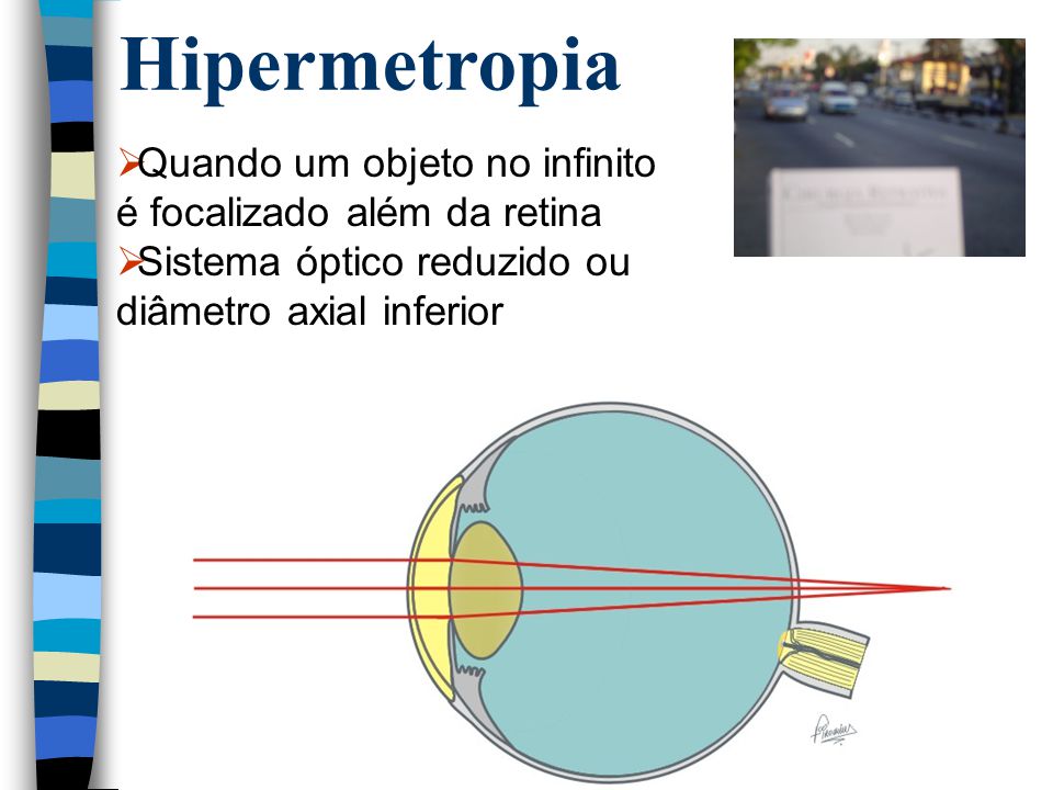 Hipermetropia Quando um objeto no infinito é focalizado além da retina