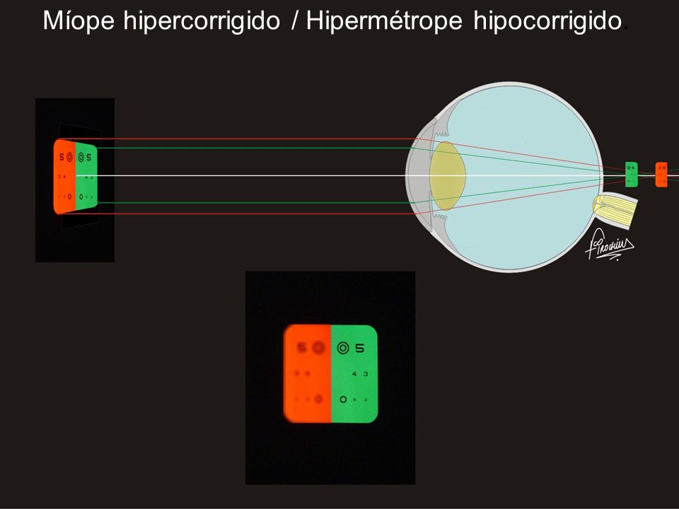 Míope hipercorrigido / Hipermétrope hipocorrigido.