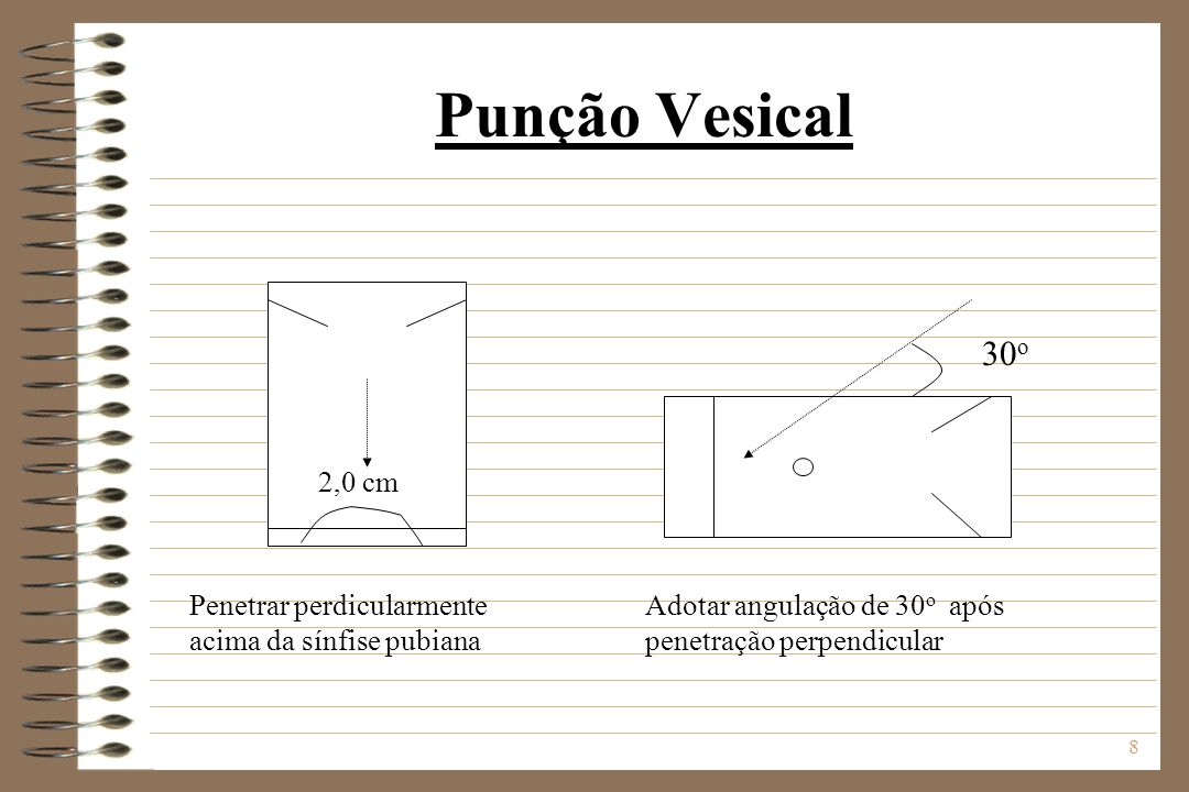 Punção Vesical 30o. 2,0 cm. Penetrar perdicularmente acima da sínfise pubiana.