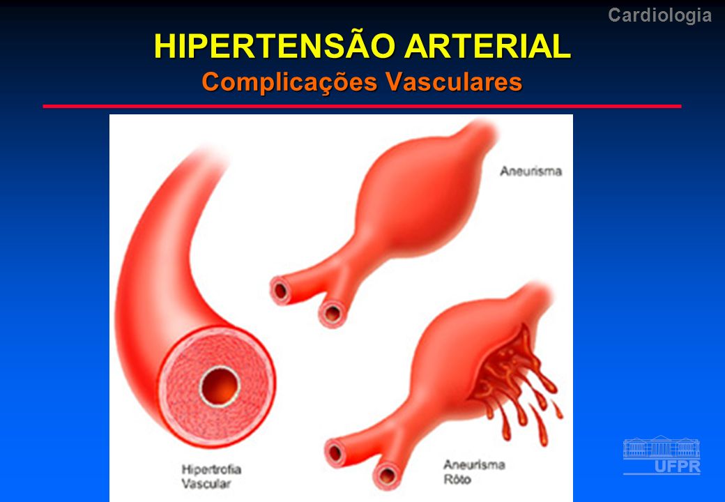 HIPERTENSÃO ARTERIAL Complicações Vasculares