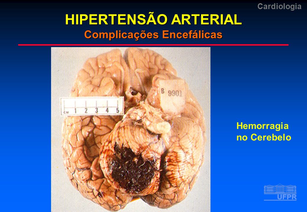 HIPERTENSÃO ARTERIAL Complicações Encefálicas