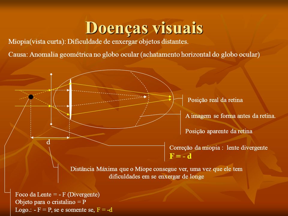 Doenças visuais Miopia(vista curta): Dificuldade de enxergar objetos distantes.