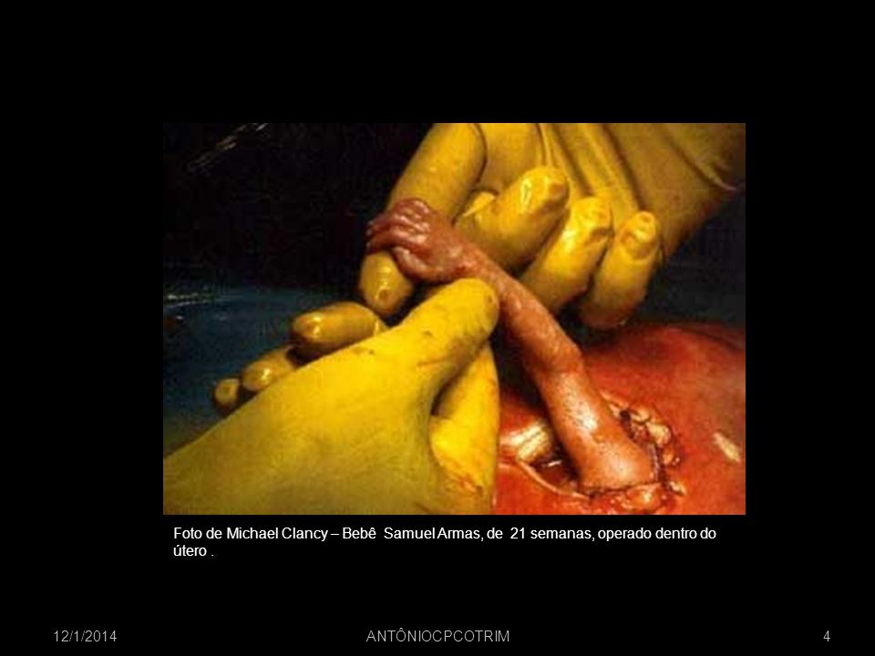 Imagem da internet Foto de Michael Clancy – Bebê Samuel Armas, de 21 semanas, operado dentro do. útero .