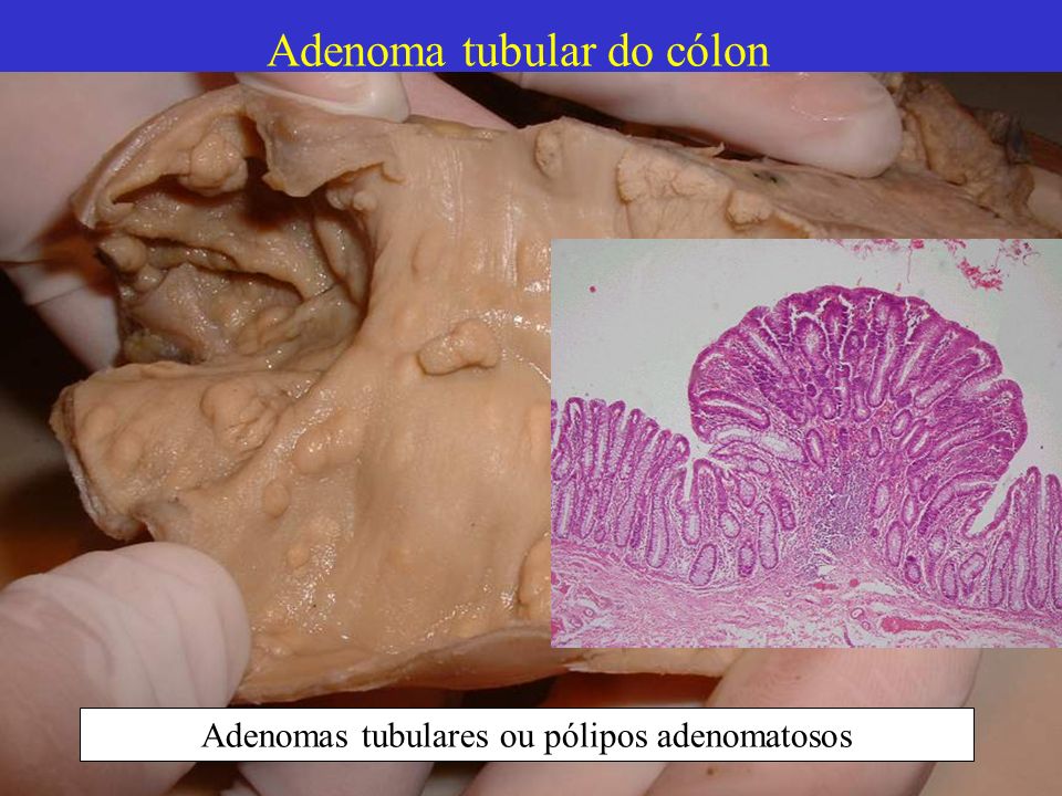 Adenoma tubular do cólon