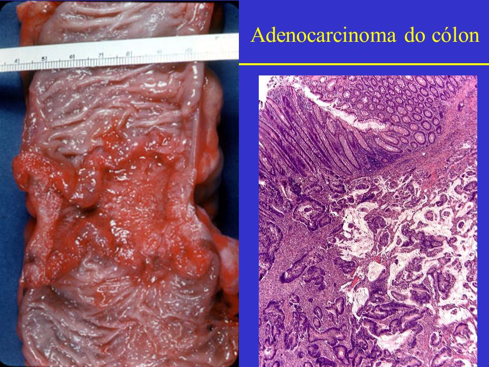 Adenocarcinoma do cólon