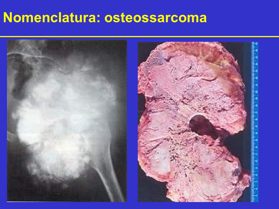 Nomenclatura: osteossarcoma