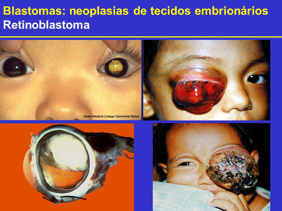 Blastomas: neoplasias de tecidos embrionários
