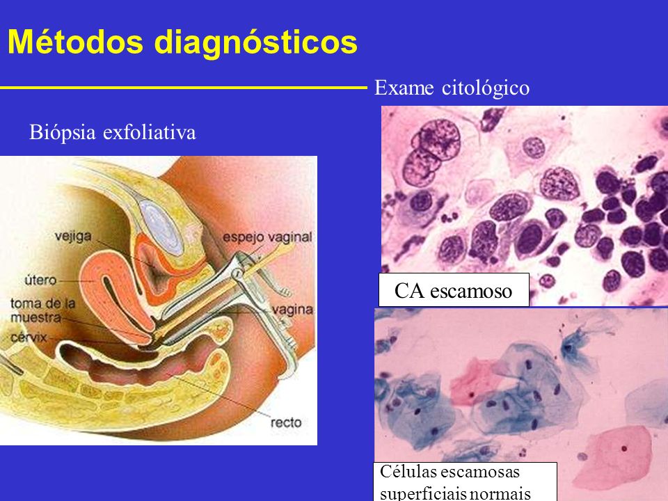 Métodos diagnósticos Exame citológico Biópsia exfoliativa CA escamoso