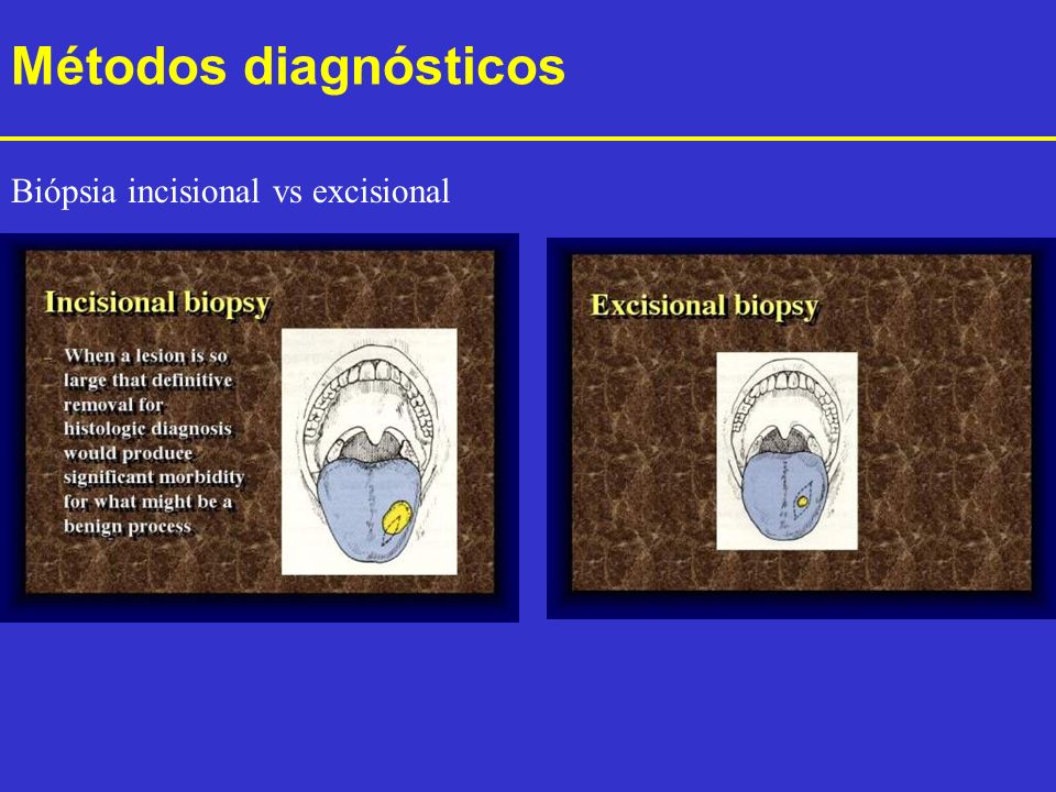 Métodos diagnósticos Biópsia incisional vs excisional